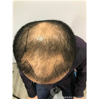 厦门毛发移植专家