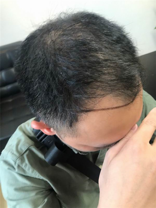 佘晓龙植发医生 