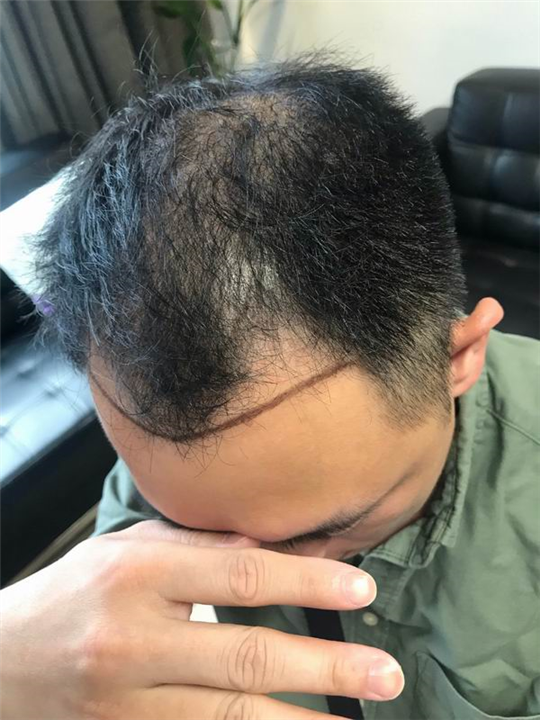 佘晓龙植发医生 
