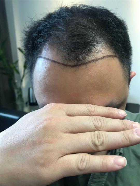 佘晓龙植发医生 
