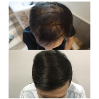 佘晓龙毛发移植专家
