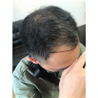 佘晓龙植发医生