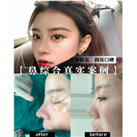 深圳鼻综合整形