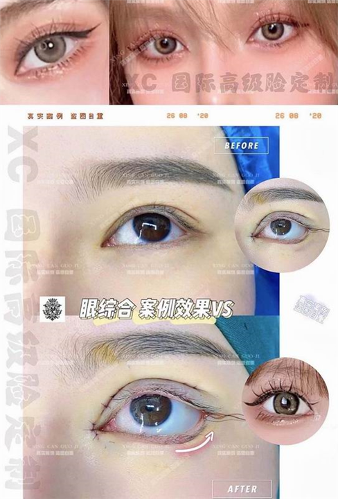 上海双眼皮整形哪家专业
