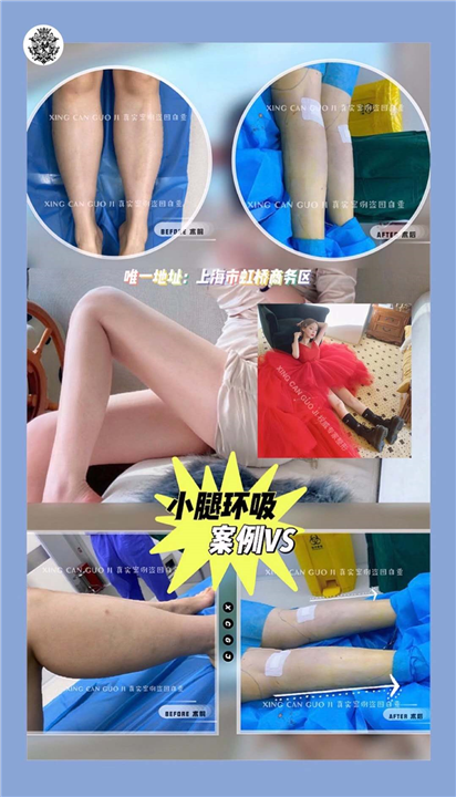 星璨小腿环吸案例 