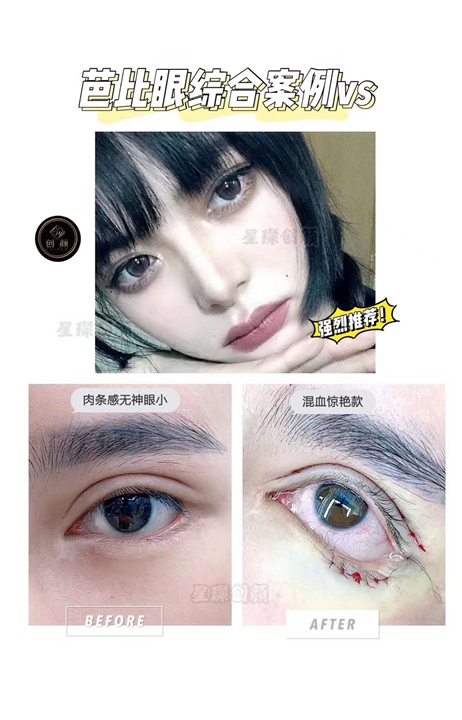 上海芭比眼综合真实案例 