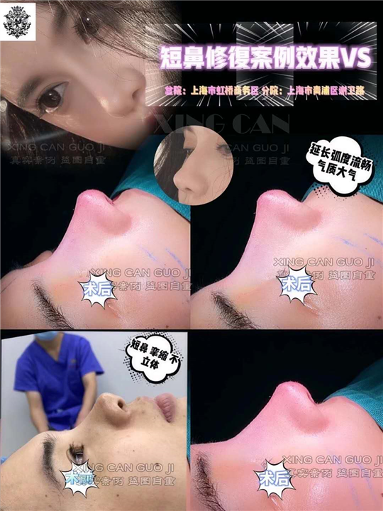 短鼻修复真实案例 