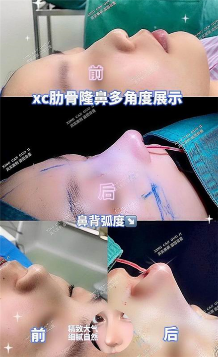 上海鼻综合整形