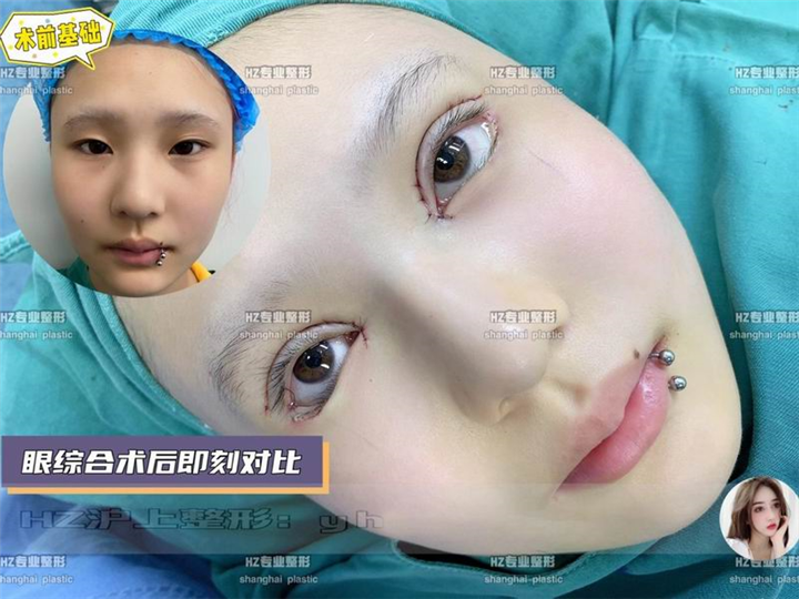上海眼综合整形