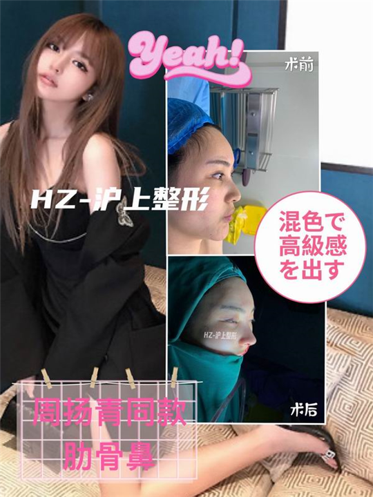 鼻整形案例