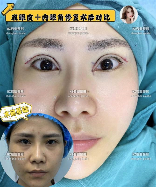 沪上眼综合整形