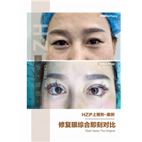 眼综合整形案例