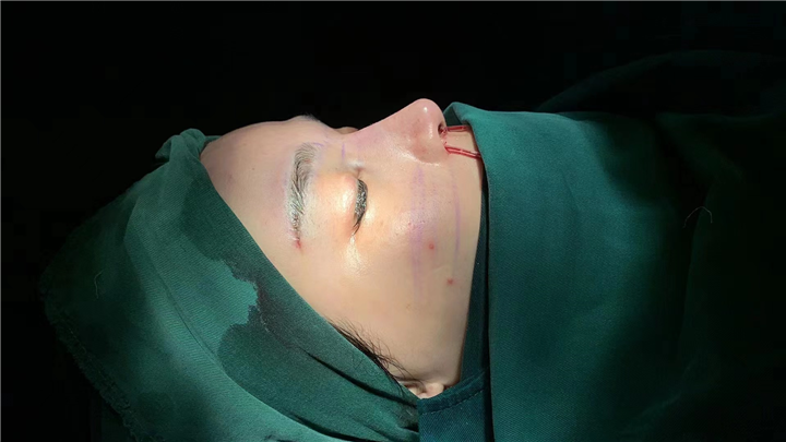 上海安禾美阁肋骨鼻整形