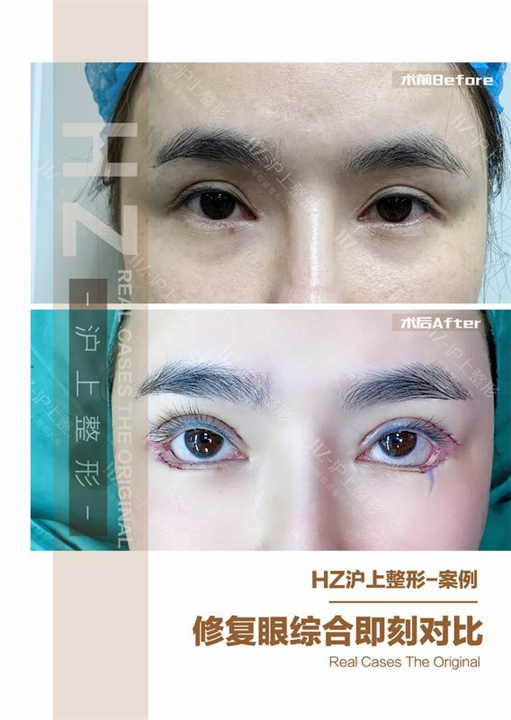 眼综合整形
