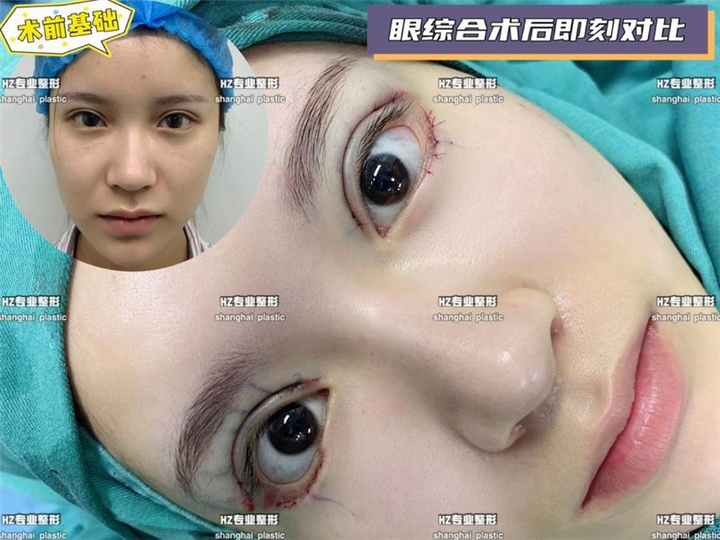 眼综合整形
