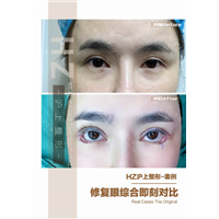 眼综合整形