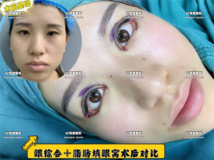 眼综合整形