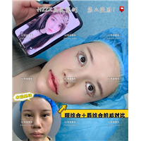眼综合整形