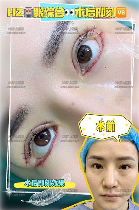 HZ眼综合整形