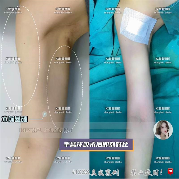 上海手臂抽脂整形