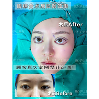 沪上眼综合整形案例