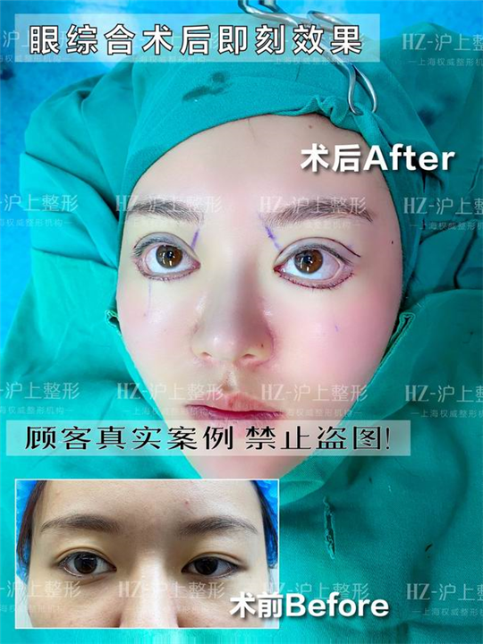 沪上眼综合整形案例