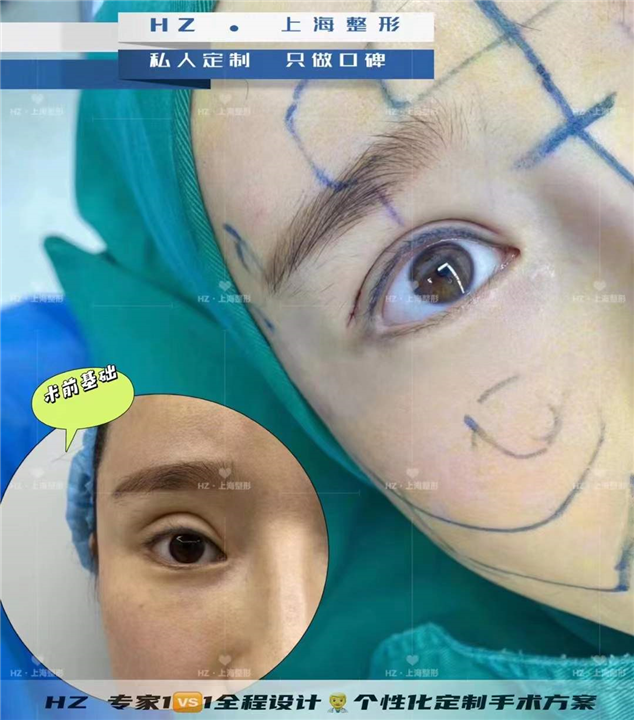 眼综合整形