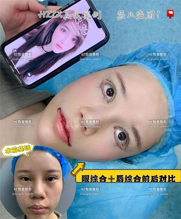 眼综合整形