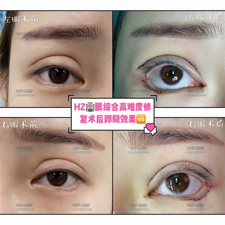 HZ眼综合整形