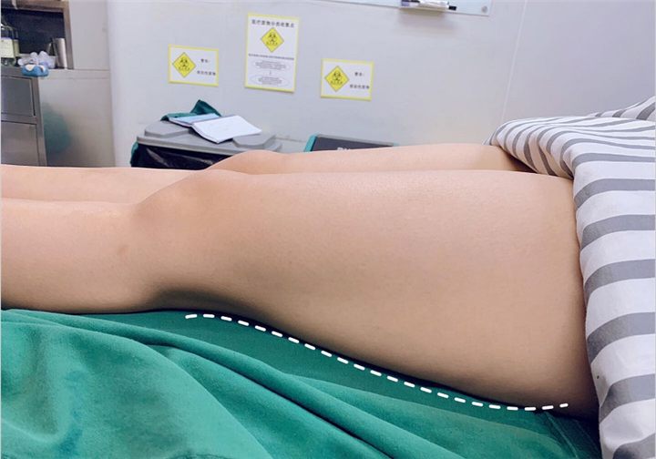 新乡腿部吸脂整形 