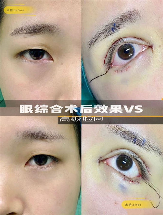 许昌双眼皮整形哪家好 