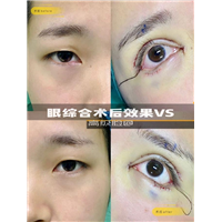许昌双眼皮整形哪家好