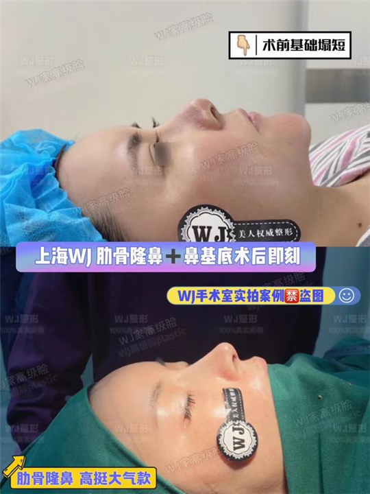 上海鼻综合整形修复