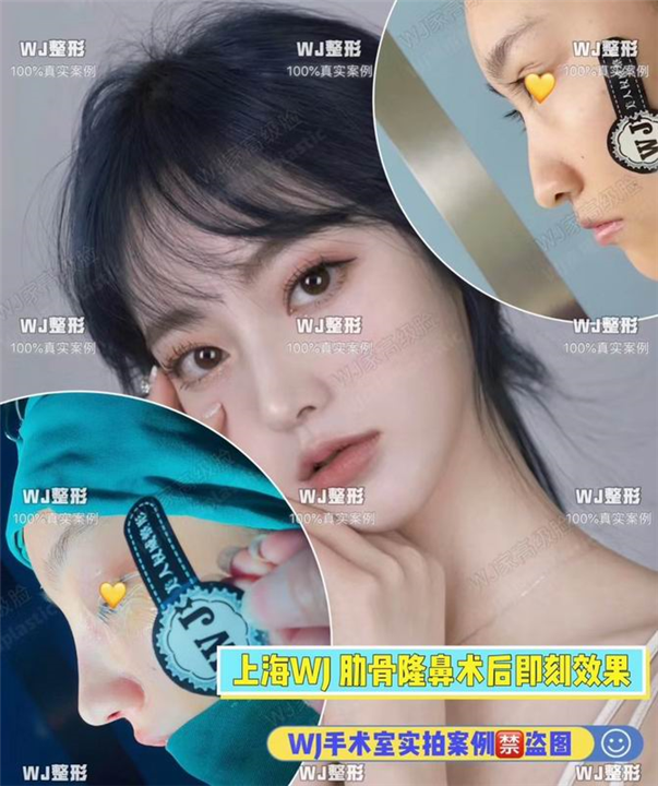 上海鼻综合整形修复