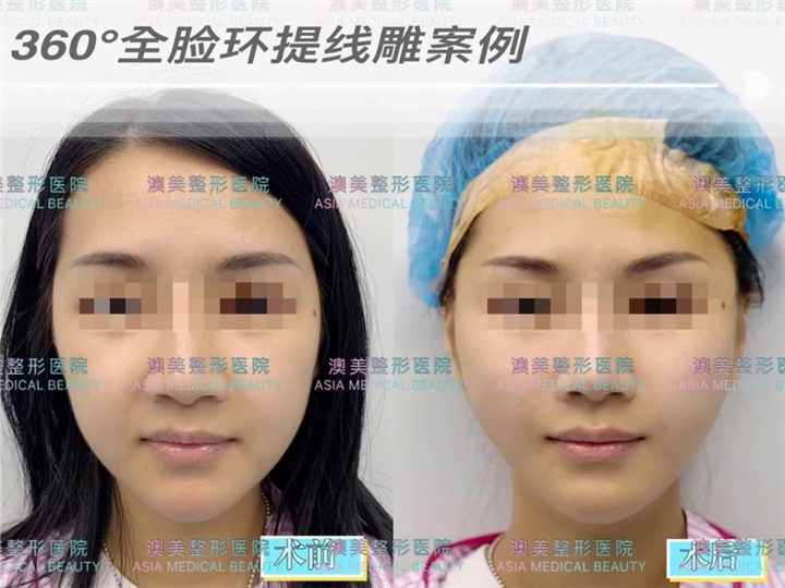 江门网红脸打造