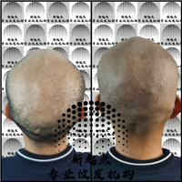广西纹发后注意事项
