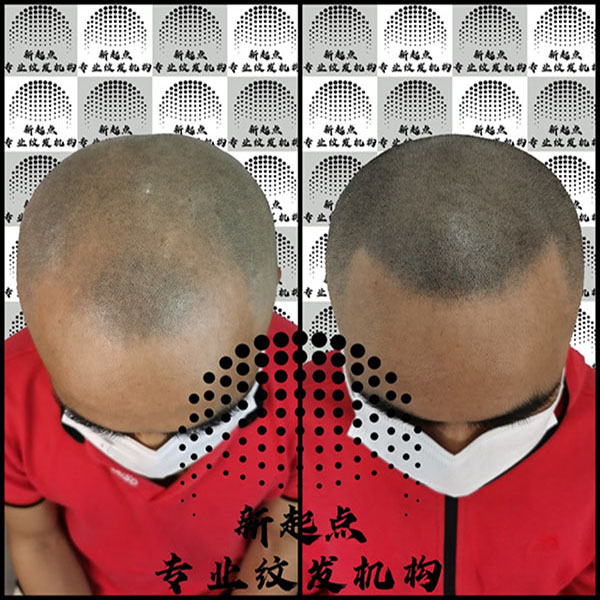 南宁SMP纹发 