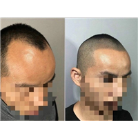 广西纹发黑科技纹发是什么意思纹发能解决什么 