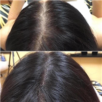 广西纹发疗程进行时会感到痛楚吗 