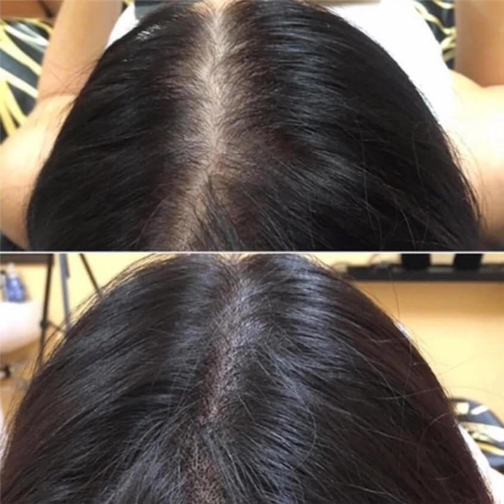 广西纹发疗程进行时会感到痛楚吗 