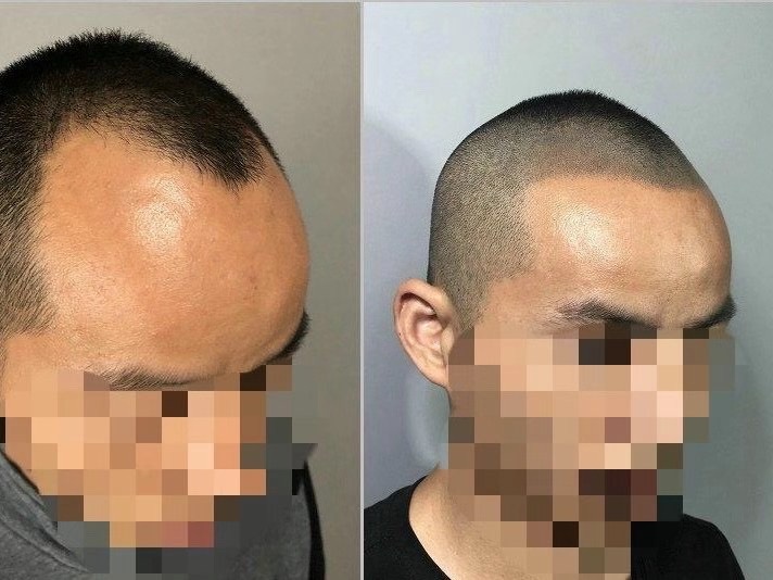 广西纹发黑科技纹发是什么意思纹发能解决什么 