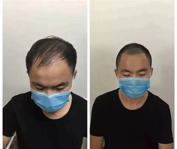 在广东纹发需要多少钱 