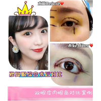 新疆眼部整形修复专家