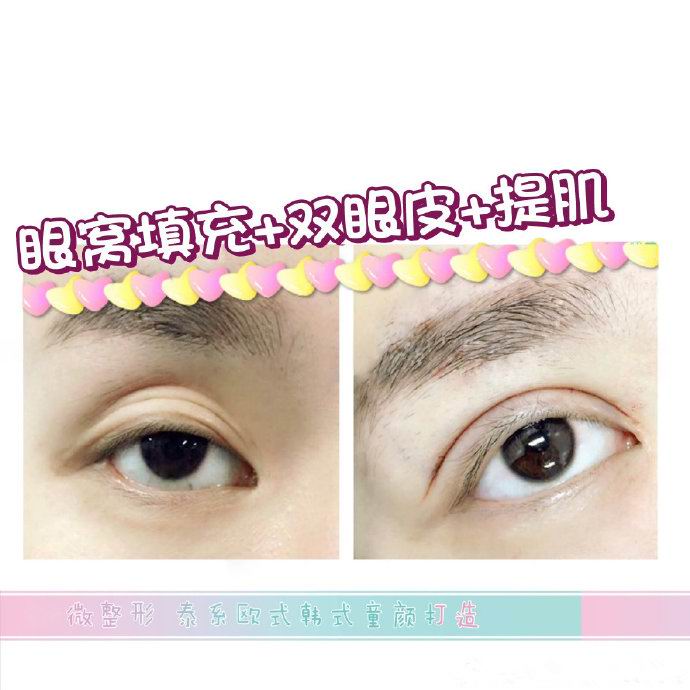新疆眼部整形专家