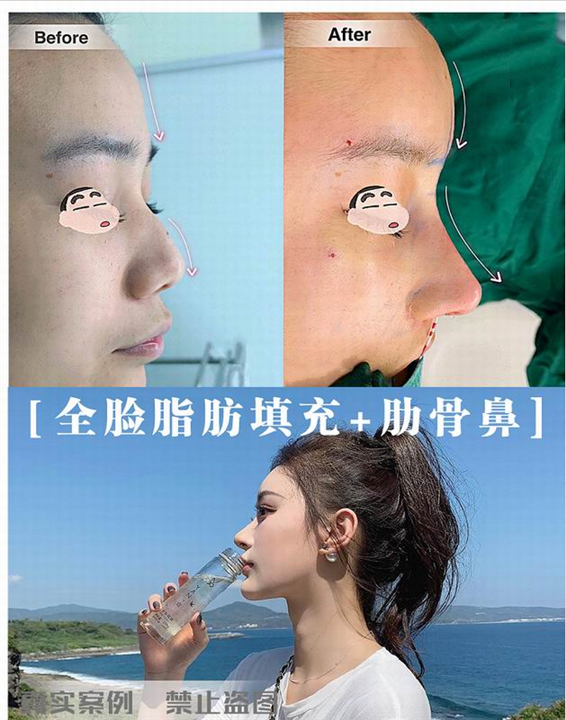 新疆自体脂肪移植专家