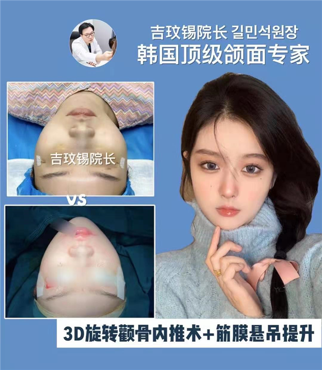 3D旋转颧骨内推术筋膜悬吊提升 