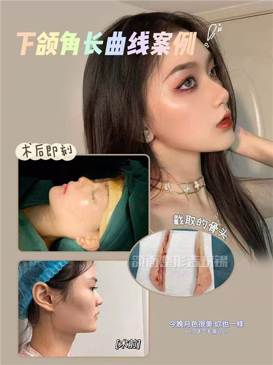 上海颌面整形吉玟锡 