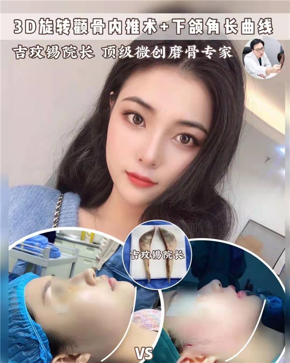 3D旋转颧骨内推术下颌角长曲线 