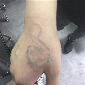 孝感洗纹身10