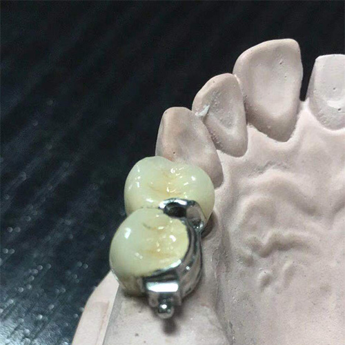 检验规格义齿 